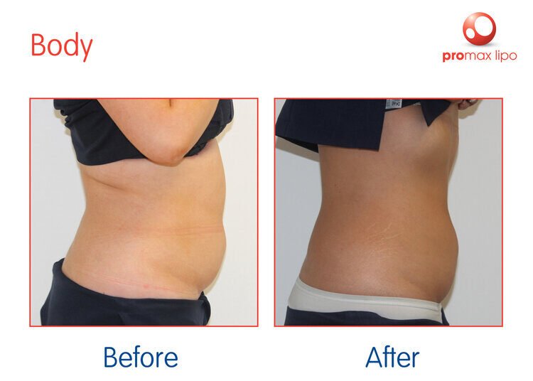 ProMax-Lipo-Body-5-Lynton-Clinic-5-Treatments-2017-Lynton_sRGB