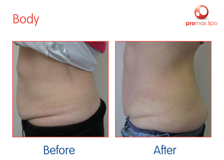 ProMax-Lipo-Body-Ruth-Jones_sRGB