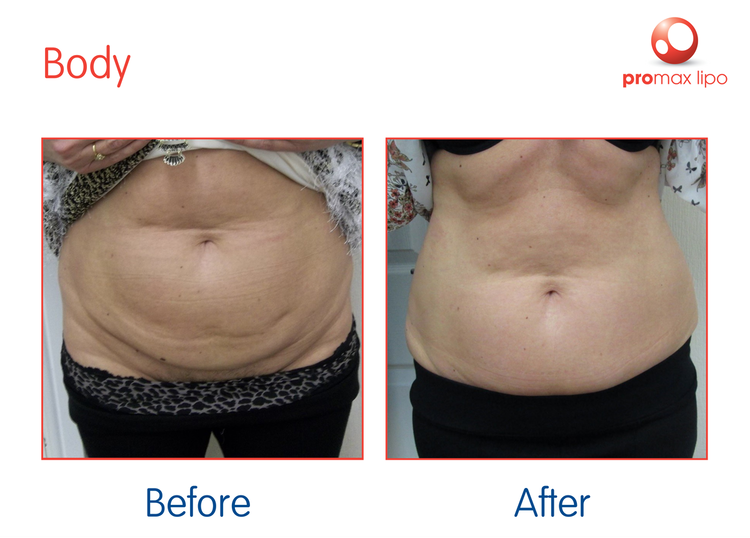 ProMax-Lipo-Ruth-Jones-LCNW--6-Treatments-2017_sRGB
